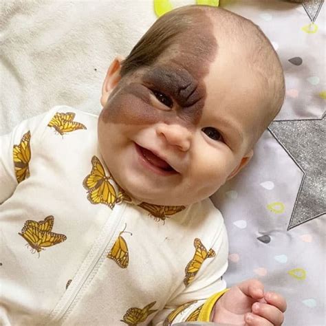 mom shares  daughters unique birthmark gathering  followers