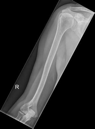 lytic bone lesion myeloma radiology case radiopaediaorg