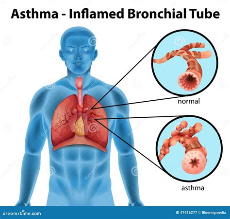 asthma inflamed bronchial tube stock vector illustration  breath