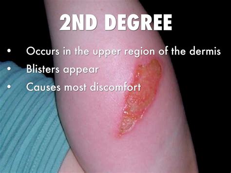 difference  st    degree burns