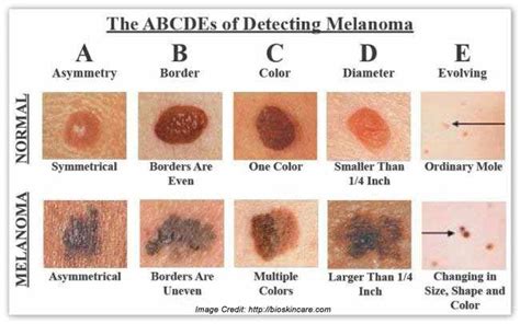 The Abcdes Of Melanoma Mayha Patel Do Faad Dermatologist