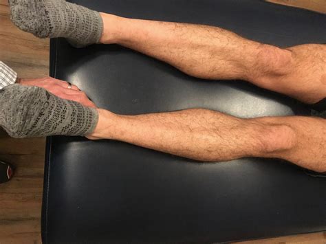 internal tibial torsion puts pressure      foot  gait guys
