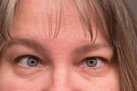 lazy eye amblyopia  symptoms  treatment myvisionorg