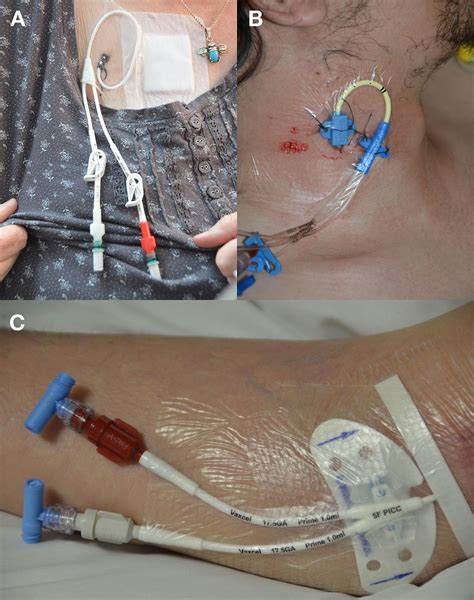 central venous catheters  bmj