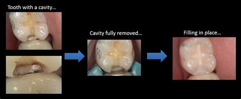 what does a cavity look like mint hill dentistry