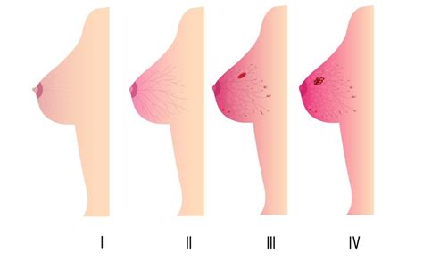 Inflammatory Breast Cancer Symptoms Stages Diagnosis Treatment