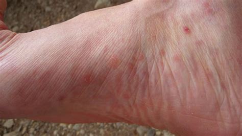 Itchy Bumps On Feet Causes Pictures And Treatment