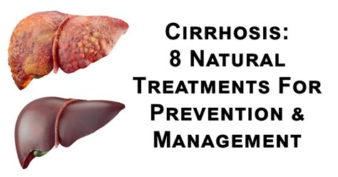 cirrhosis 8 natural treatments for prevention and management david