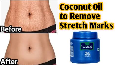 Remove Stretch Marks Fast And Easily From All Body Parts How To