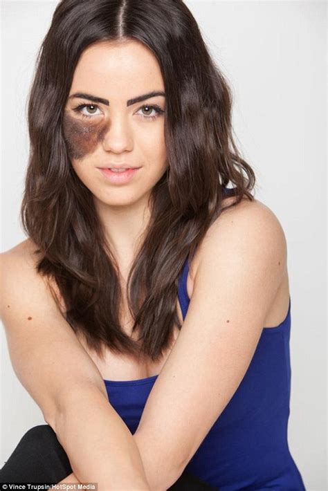 cassandra naud with huge birthmark on her face refuses surgery daily