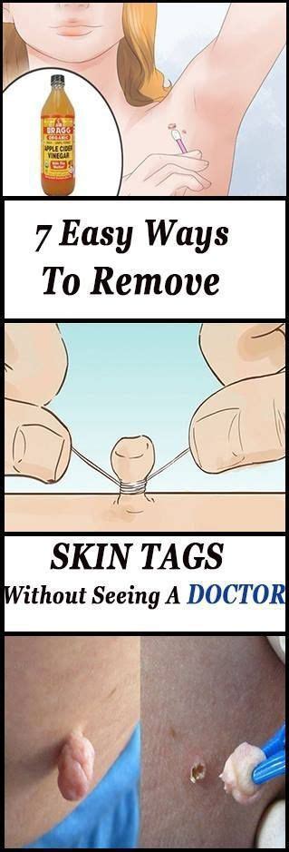 7 steps to remove skin tags without seeing a doctor good healthy