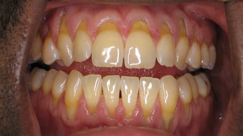 receding gums symptoms diagnosis   treatment
