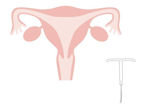 iud on white illustrations royalty free vector graphics and clip art
