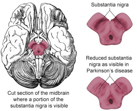 Parkinson Disease Pd Stepwards