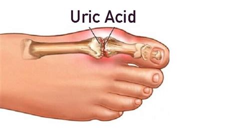 importance   uric acid tests  rid  gout