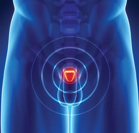 brachytherapy offers favorable long term prostate cancer