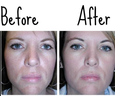 before and after using vaseline for wrinkles vaseline uses for face eye wrinkle vaseline for