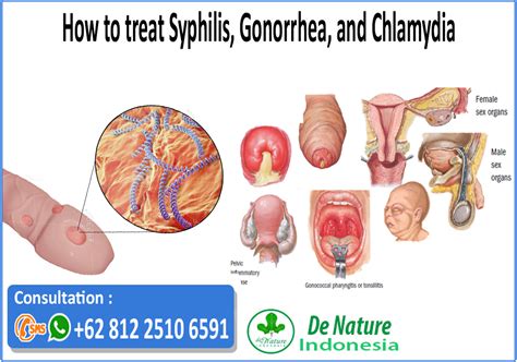 Syphilis Symptoms And Treatment