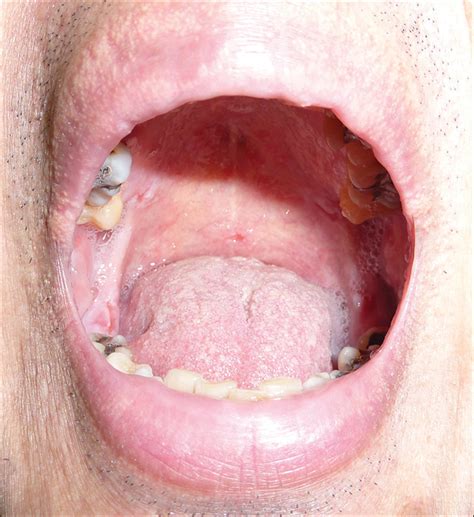 Painful Oral And Genital Ulcers Mdedge Dermatology