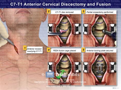 C7 T1 Anterior Cervical Discectomy And Fusion