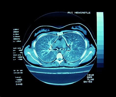 Ct Scan Showing Normal Lungs Photograph By Simon Fraser Science Photo
