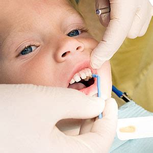topical fluoride offers  protective boost  children  high risk