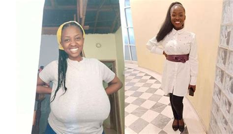 My Struggle With Big Breasts 3 5kgs Were Taken Off My Chest