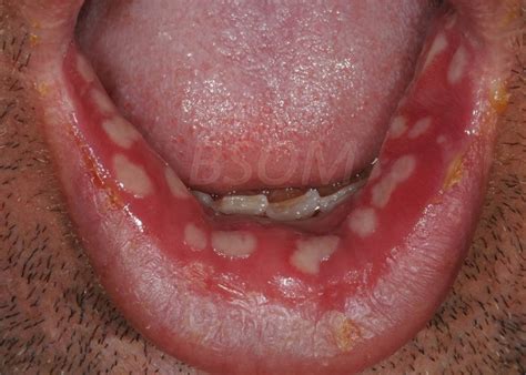 Sudden Onset Painful Mouth Ulcers Herpes British And Irish Society