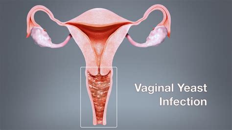 vaginal yeast infection causes symptoms and natural remedies