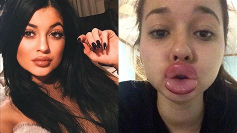 teens are using shot glasses to mimic kylie jenner s lips and it looks