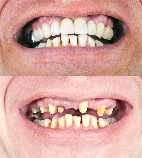 สะพานฟัน dental bridge คลินิกทันตกรรมโลตัสอ่อนนุช จัดฟัน ฟอกสีฟัน