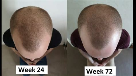 Scalp Massage For Hair Loss [48 Weeks] Top Hair Loss Treatments Youtube