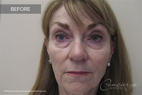 Before And After Photos Juvederm And Botox Cosmetic