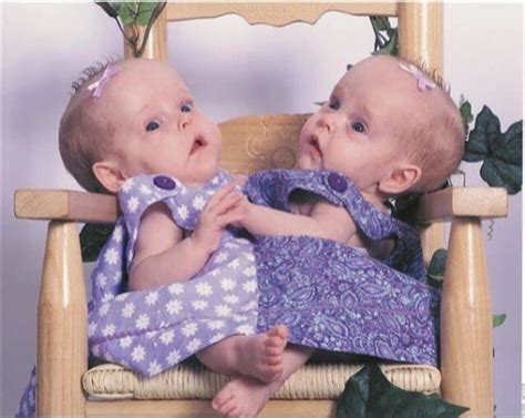 Exploring The Dynamic World Of Conjoined Twins Kendra And Maliyah