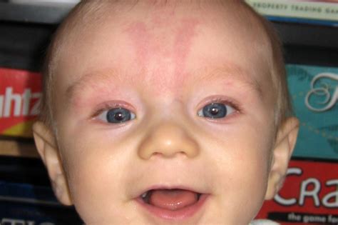 red marks  forehead   treatable dermatology skin