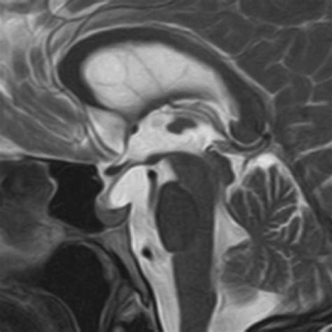 t2w sagittal mri another patient non neoplastic pathology of the