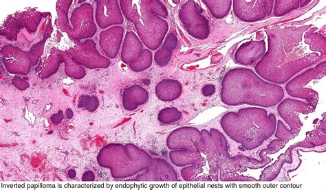 pathology outlines sinonasal papilloma