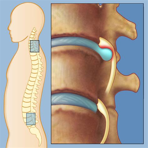 herniated disc weill cornell brain  spine center