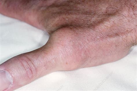 arthritic thumb stock image  science photo library