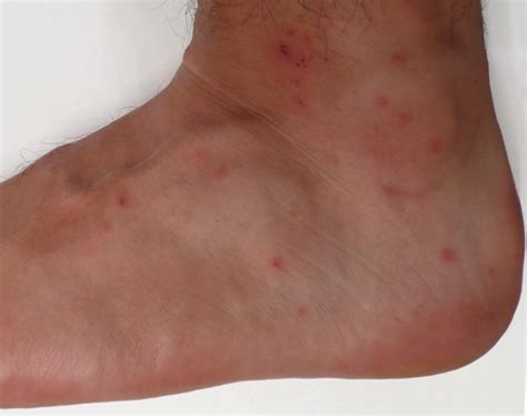 What Do Bed Bug Bites Look Like 7 Bite Symptoms With