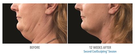 rid   double chin  freezing fat laser aesthetic center