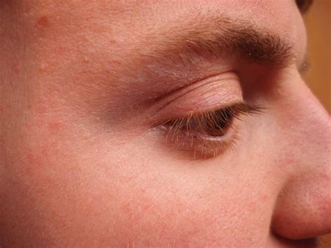 virtual grand rounds  dermatology  unusual eyelid dermatitis
