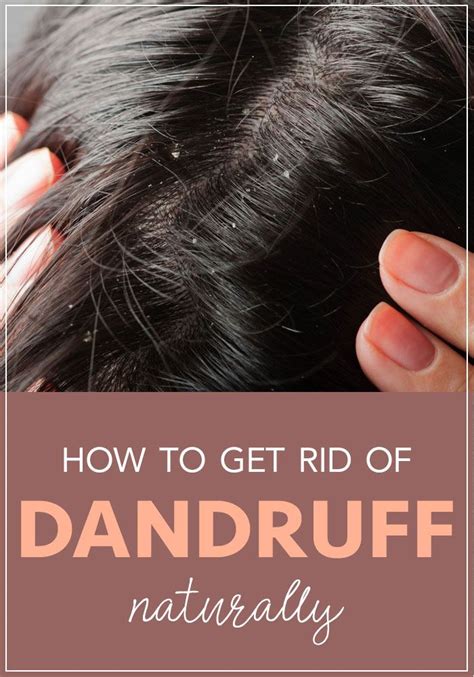dandruff  treatment  prevention dandruff dry scalp treatment dandruff remedy