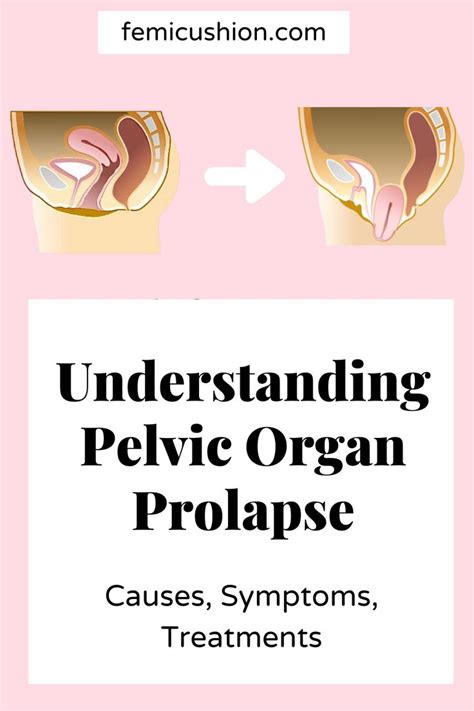 Pin On Pelvic Organ Prolapse 101