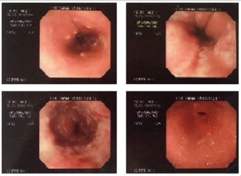 Esophagitis Concise Medical Knowledge