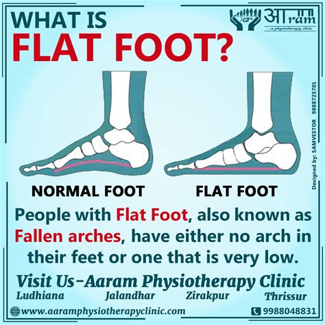 flat foot definition symptoms  rehabilitation exercises