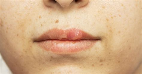 Small Red Bumps Around Mouth Livestrong