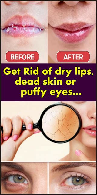 Get Rid Of Dry Lips Dead Skin Or Puffy Eyes… Womenbelle Dry Lips