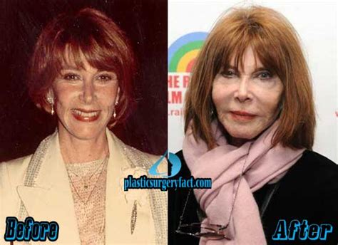 Lee Grant Plastic Surgery Before And After Plastic