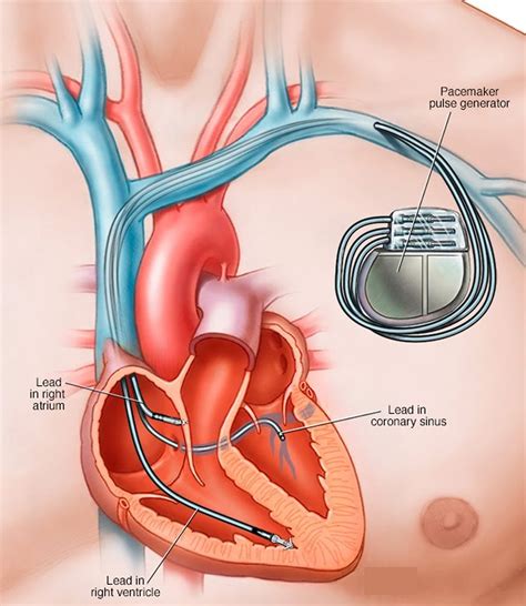 pacemaker heart pacemaker indications   pacemaker work